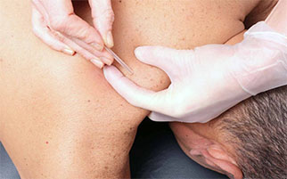 Dry Needling