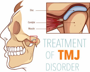 What Causes Jaw Pain Or Tmj Lee Miller Rehabilitation Associates