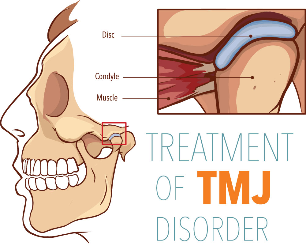 Treatment of (TMJ) disorder.